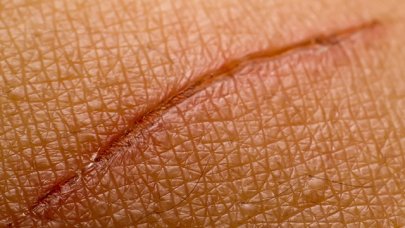 Oštećena koža - ožiljci